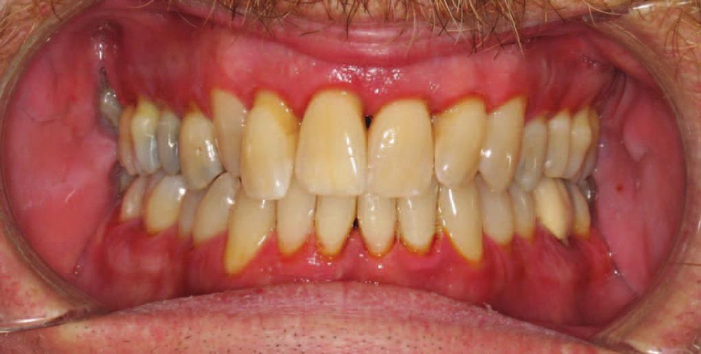 Unresponsive to non-surgical treatment Continued worsening of condition after treatment Red, swollen gums Bleeding on probing* Pus present* Varying degrees of root exposure Plaque & calculus present*