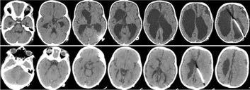 Limited Sequence versus Entire Scan Scans limited to region of interest for evaluating clinical conditions during repeat studies Example: Follow-up of shunt position in hydrocephalous patients No