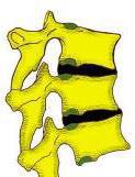Osteotomies 1. partial facet joint 2. complete facet joints 3. partial body# 4.
