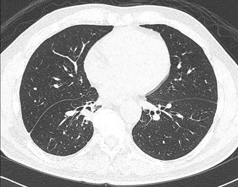 However, some doubts about the significance of invasive procedures for very early lung cancer have been noted (16).