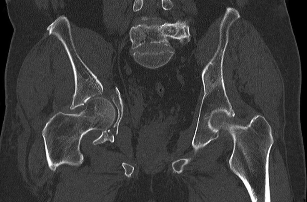 The post-operative AP pelvic radiograph (c) demonstrates posterior column and a total hip replacement that successfully treated this injury. accurately, will keep their native hip joint and avoid THR.