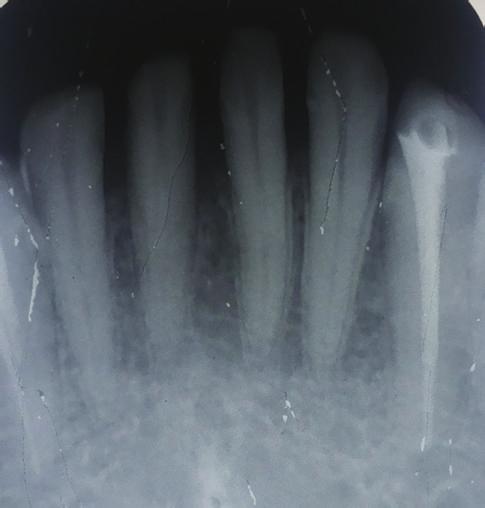 2 Case Reports in Dentistry Figure 1: Preoperative radiograph. Figure 3: Radiograph showing two different instruments ( H file andreamer)intwocanalsin31and32.