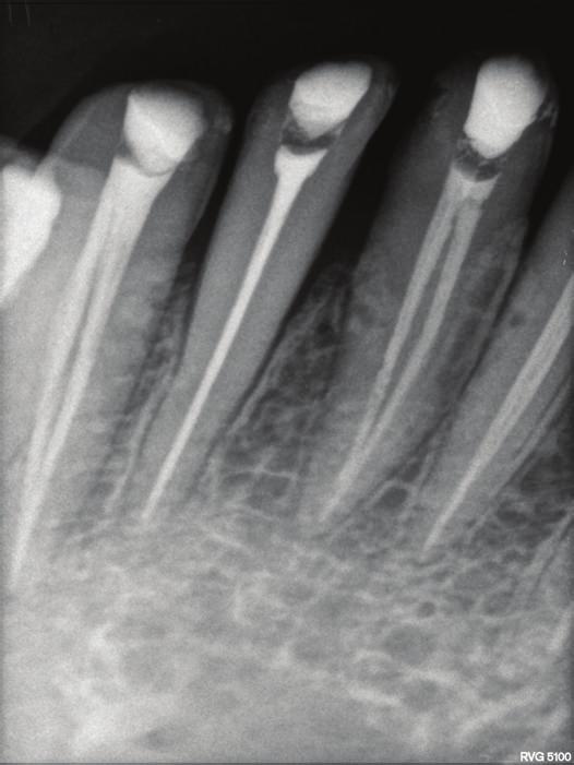 One of the main reasons Figure 8: Radiograph showing obturation in two separate canals in 32 and 41.