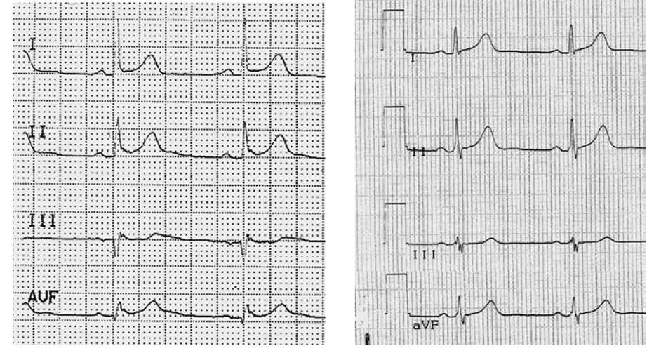 Ablation of Early Repolarization Pattern with Quinidine 42 y, m, 36 episodes of VF during 24 months FU 42 y, m,