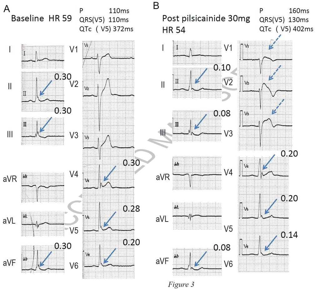 ERS: Response to Na-channel block Twelve-lead ECGs in a patient with Brugada syndrome under baseline conditions (A) and after pilsicainide administration (B).