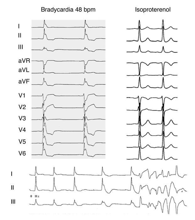 Acute Therapy of VT/VF Storm in Early Repolarization Syndrome with Isoproterenol Multiple episodes of VF and