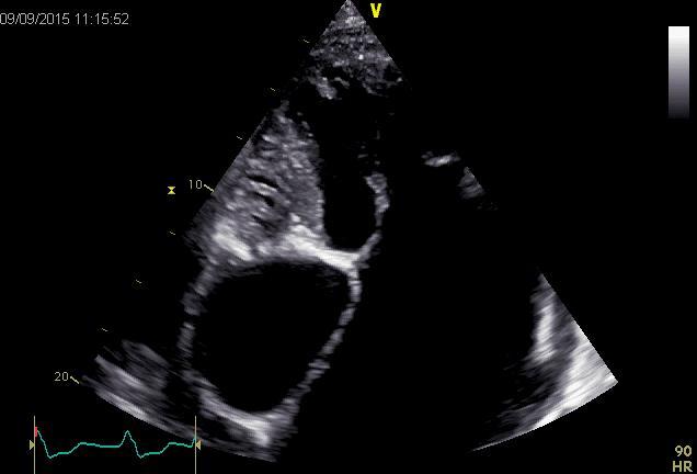 ventricle, ventricular septal defect,