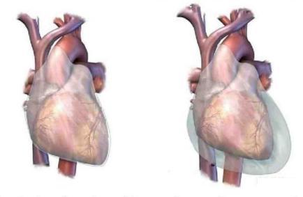 Pericardial syndromes o Acute and recurrent pericarditis, isolated pericardial effusion, and