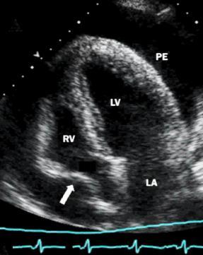 Features of cardiac tamponade in pulmonary arterial hypertension o Diagnosis of cardiac tamponade in a patient with severe PAH is challenging.