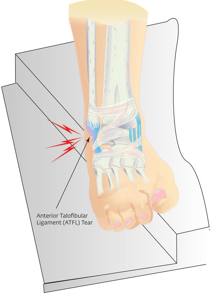 Ankle Pain? At some time in your life you may experience foot, heel, or ankle pain. There are an estimated 25,000 people who sprain an ankle every day in the United States.