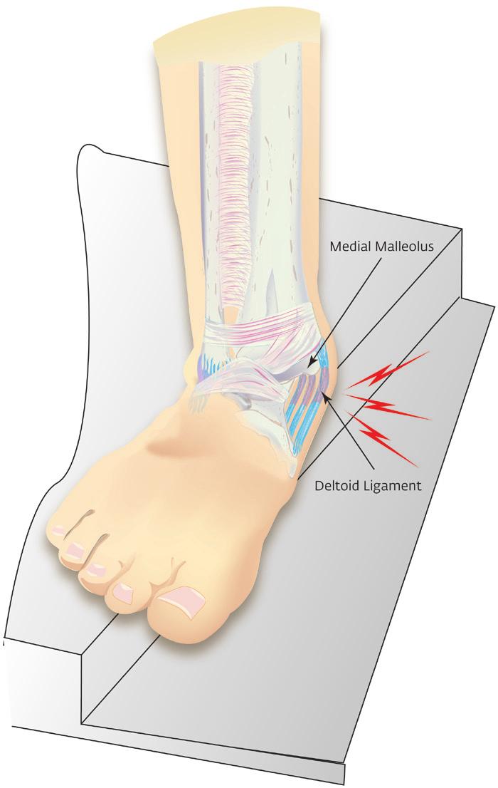 Eversion Ankle Sprain Eversion ankle sprains occur less often and are usually more severe.