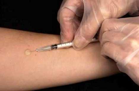 Mantoux Tuberculin Skin Test Tuberculin is made from proteins derived from inactive tubercle bacilli 0.