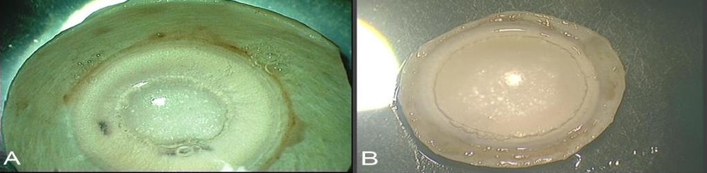6.2 Materials and methods Twenty sclero-corneal discs from human eye bank donor eyes were studied.