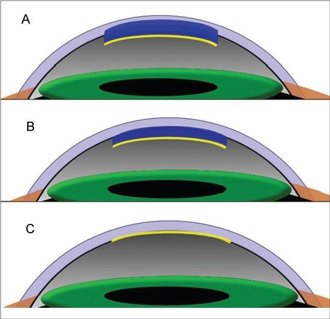 Figure 1.5 (A) In deep lamellar endothelial keratoplasty, Descemet's membrane and posterior corneal stroma is removed.