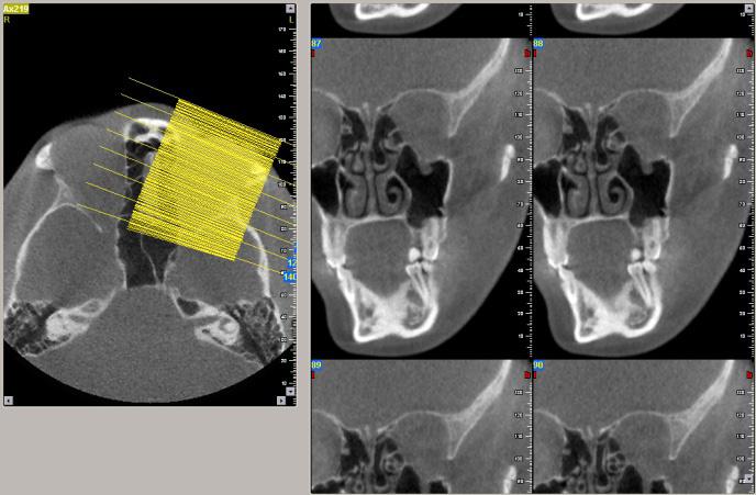 Original Research Figure 3. CBCT oblique coronal extracted sections. Figure 4.