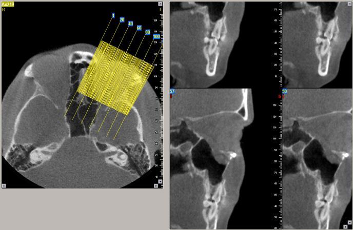 Additional inclination of the designed curve for sagittal sections. Figure 7. CBCT. Oblique coronal sections.