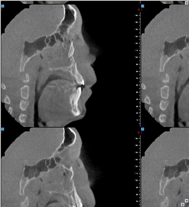 the maxillary sinus and the capacity to measure correctly the displacement on different reformatted sectioning.