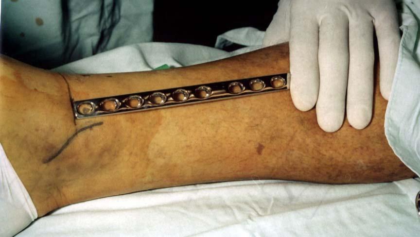Skin incision at medial
