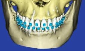 This scan is required if the patient has a certain number of teeth with restorations that cannot be accurately modeled