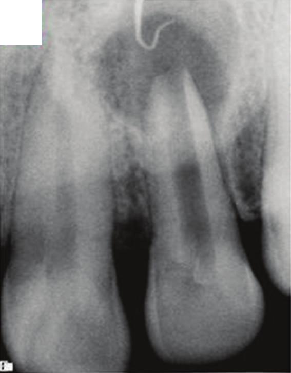 2 Case Reports in Dentistry (a) (b) (c) (a) (b) (c) Figure 1: (a) An immature, maxillary right lateral incisor with open apex and large localized, well-defined periapical radiolucency in a 40-