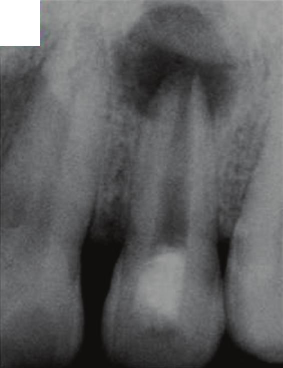 (c) At 1-year follow-up, normal bony architecture around the entire root is reestablished. Note the narrowing of the apical third of the root canal.
