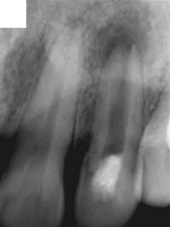 Endodontic access cavity was prepared using appropriate armamentarium (LA Axxess kit) (Sybronendo, CA, USA) under rubber dam isolation. The canal was copiously flushed with triple distilled water.