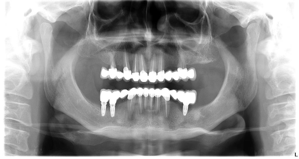 Slika 1.Kronični periapikalni procesi u donjoj čeljusti. Preuzeto s dopuštenjem: dr. dent. med. Darko Banožić. 2.3.