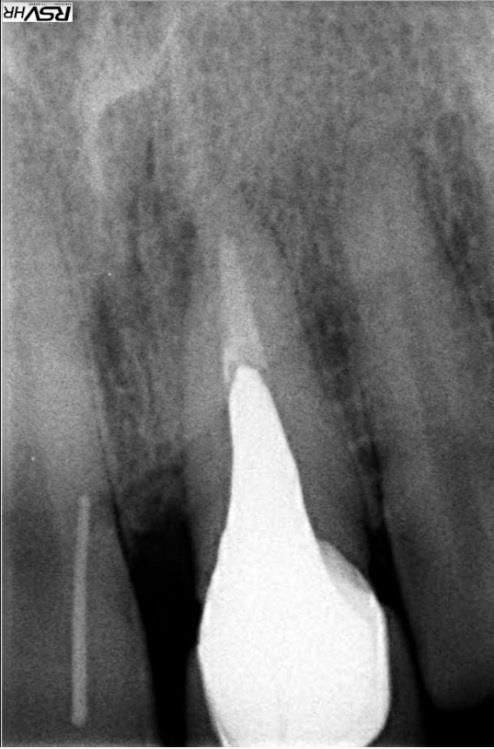 Slika 2. Ciljana snimka zuba sa štapićem gutaperke. Preuzeto s dopuštenjem: dr. dent.med. Marija Rašin.