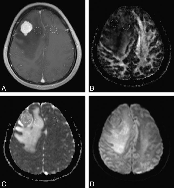 Fig 1. ADC and FA measurements in a 54-year-old woman with a pathologically confirmed classic meningioma arising in right frontal convexity.