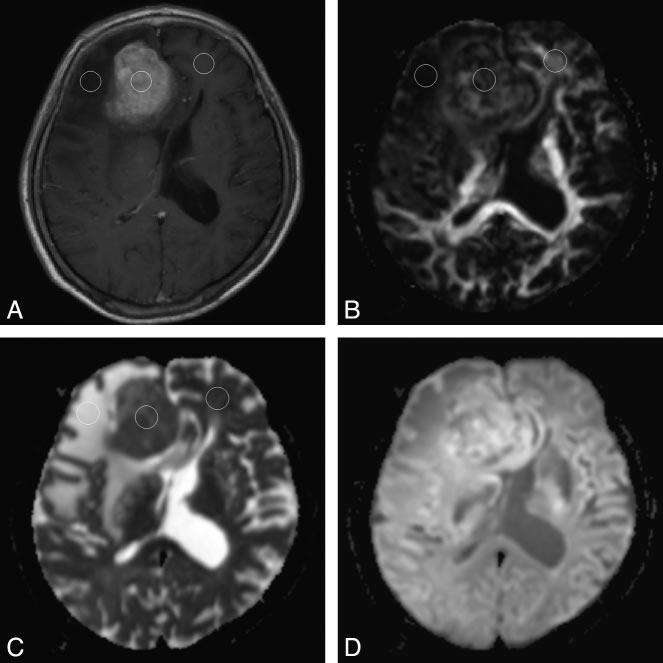 Fig 2. A 64-year-old woman with an atypical meningioma in the right frontal region confirmed on pathologic examination.