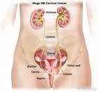 Chemoradiation Stage III Cervical Cancer Treatment Stage III: Tumor extends to the pelvic wall and/or involves lower