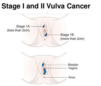Vulvar Cancer Stage IA <2cm size, <1mm depth Stage IB Any