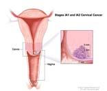 org/professionals/physician_gls/pdf/uterine.pdf Stage I Cervical Cancer Treatment Stage I: Tumor confined to cervix CAN YOU SEE IT?