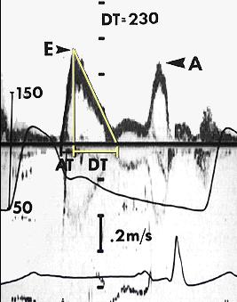 IV. Mitral Inflow: E/A velocity pitfalls - Beam Alignment: parallel to mitral inflow - Proper sample volume size (1-2 mm) Correct Sample Volume