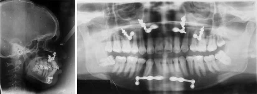 JIOS Orthodontic-Surgical Management of a Skeletal Class II Patient with Reverse Smile Arc and Vertical Maxillary Excess Fig.
