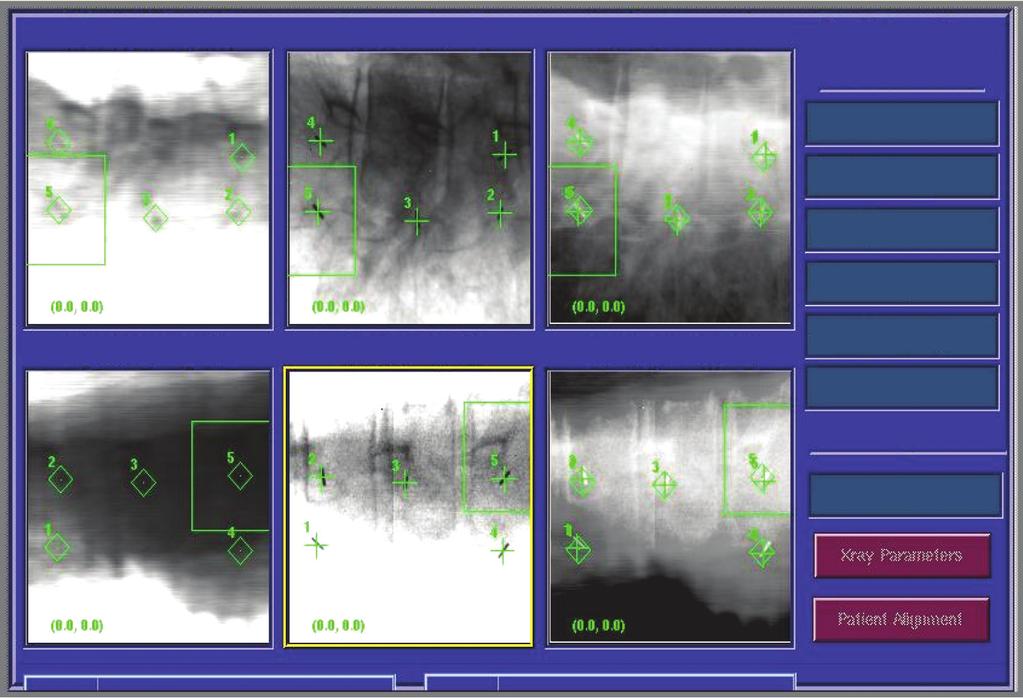 Image-guided Radiosurgery Synthetic Image A Camera Image A 425 Overlay of Images A Couch Corrections Current Node RGT: 4.9mm ANT: 1.4mm INF: 2.8mm LFT: 2.