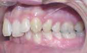 Case: Kt, adult female, Full CLII dental/skeletal (Wits +8). TP: camouflage CLII, extraction of 4 premolars. Protrusion of maxillary incisors, severe mandibular crowding (20 mm).