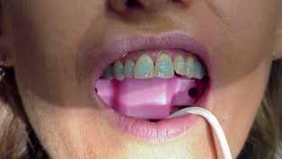 Do not let saliva touch the teeth after rinsing and drying.