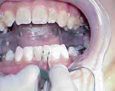 After etching, rinse, dry and do not let saliva touch the teeth