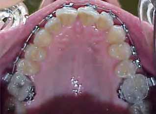 The wire is placed through the molar