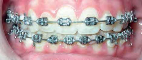 settle-in premolars