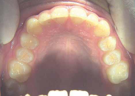 ¾ CLII div II. OB = 5 mm. Short face, MPA = 33. Wits = +3.5. Patient doesn t like her smile.
