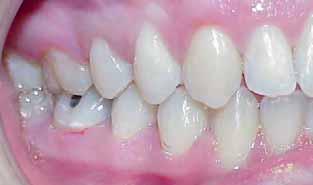 At the end of treatment, the MAX incisors appeared too short compared to the canines &