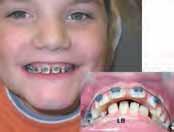 6. Case: Ke, female, 12 years old, dental age 11.5. CLII div II. OB = 10 mm. Deep CoS (4 mm).