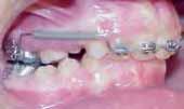 HG and the TPA to provide vertical anchorage to the maxillary posterior segment and for maxillary Growth Modification.