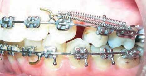 Stripping of MAND incisors at each