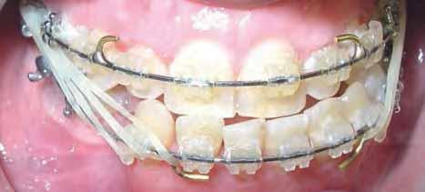 Of note: on the right side, both elastics could as well be attached simultaneously to the
