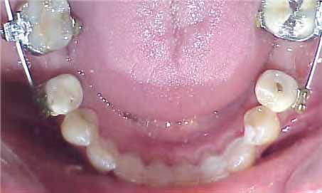 periodontal splint metal mesh with