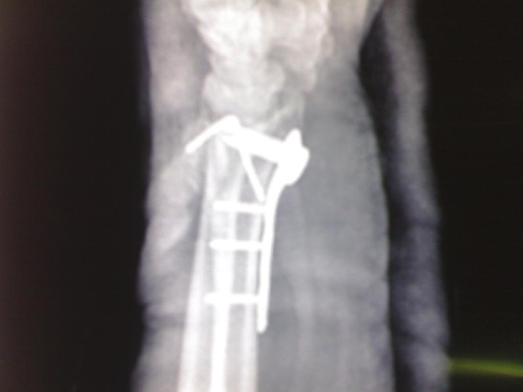 The second case too was of an AO type C3 fracture in an eighteen-year-old male patient.