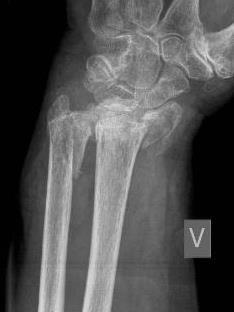 Fracture stability The key to offer a good and correct treatment is to